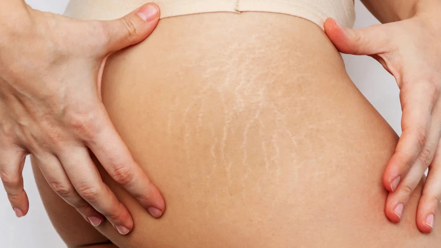 What to Do About Stretch Marks - Spa MDSpa MD