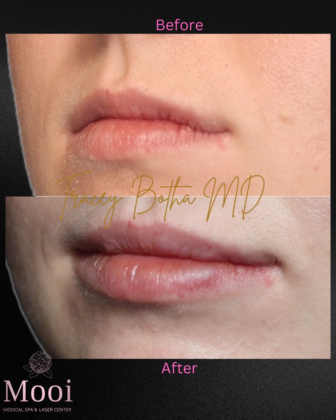 Luscious Lips-Filler