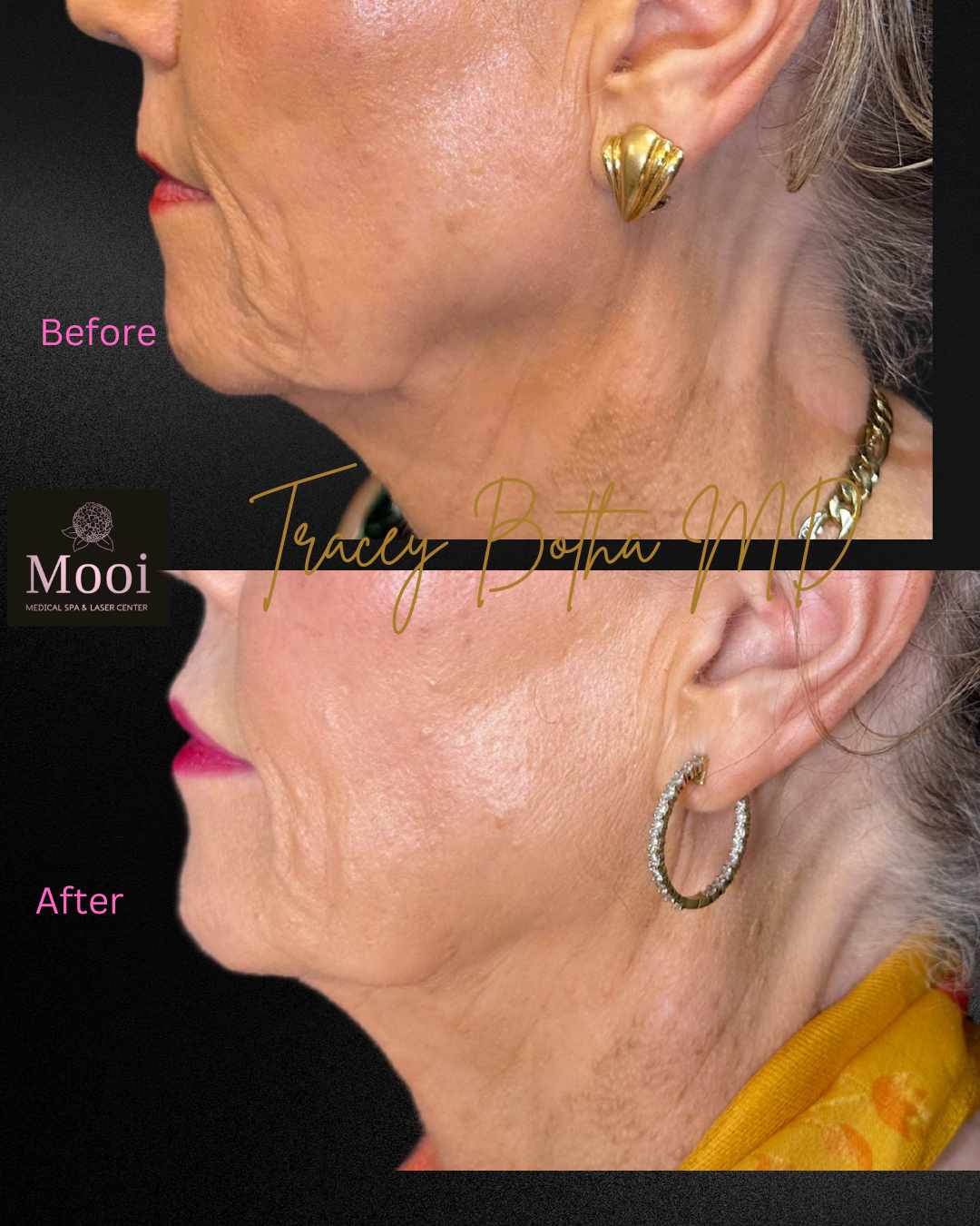 Biostimulators