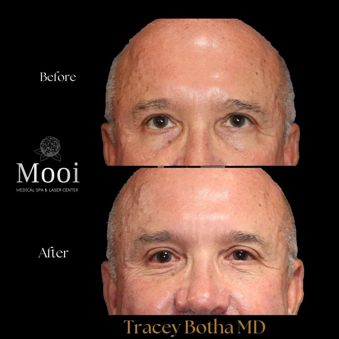 Biostimulators
