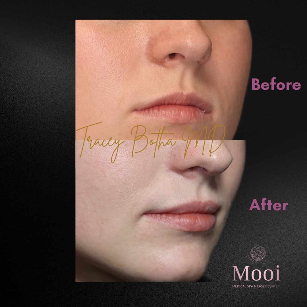 Luscious Lips-Filler