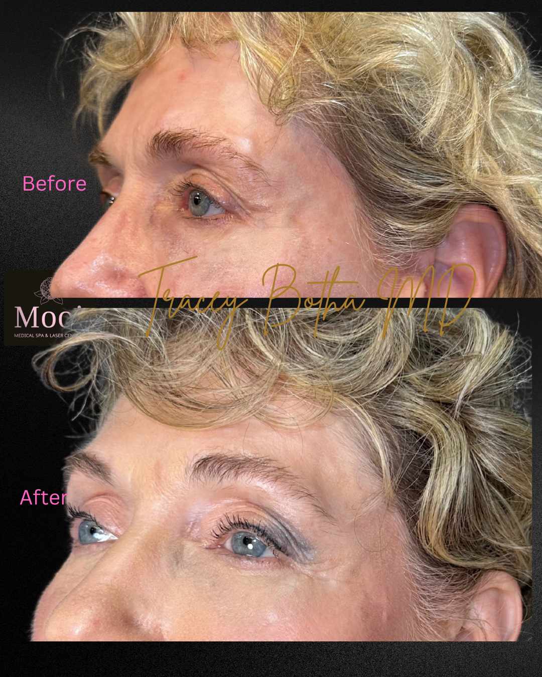 Botox
