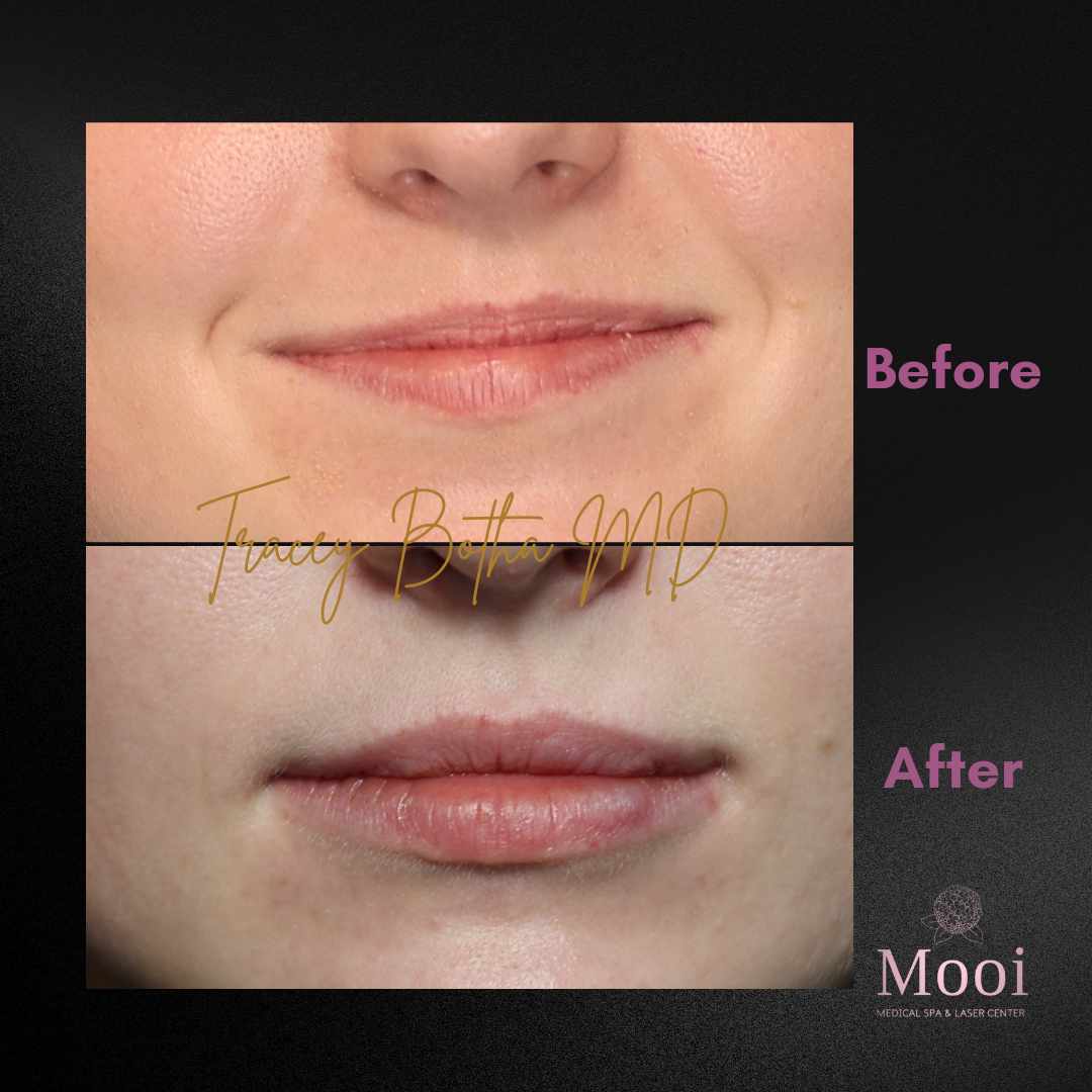 Luscious Lips-Filler