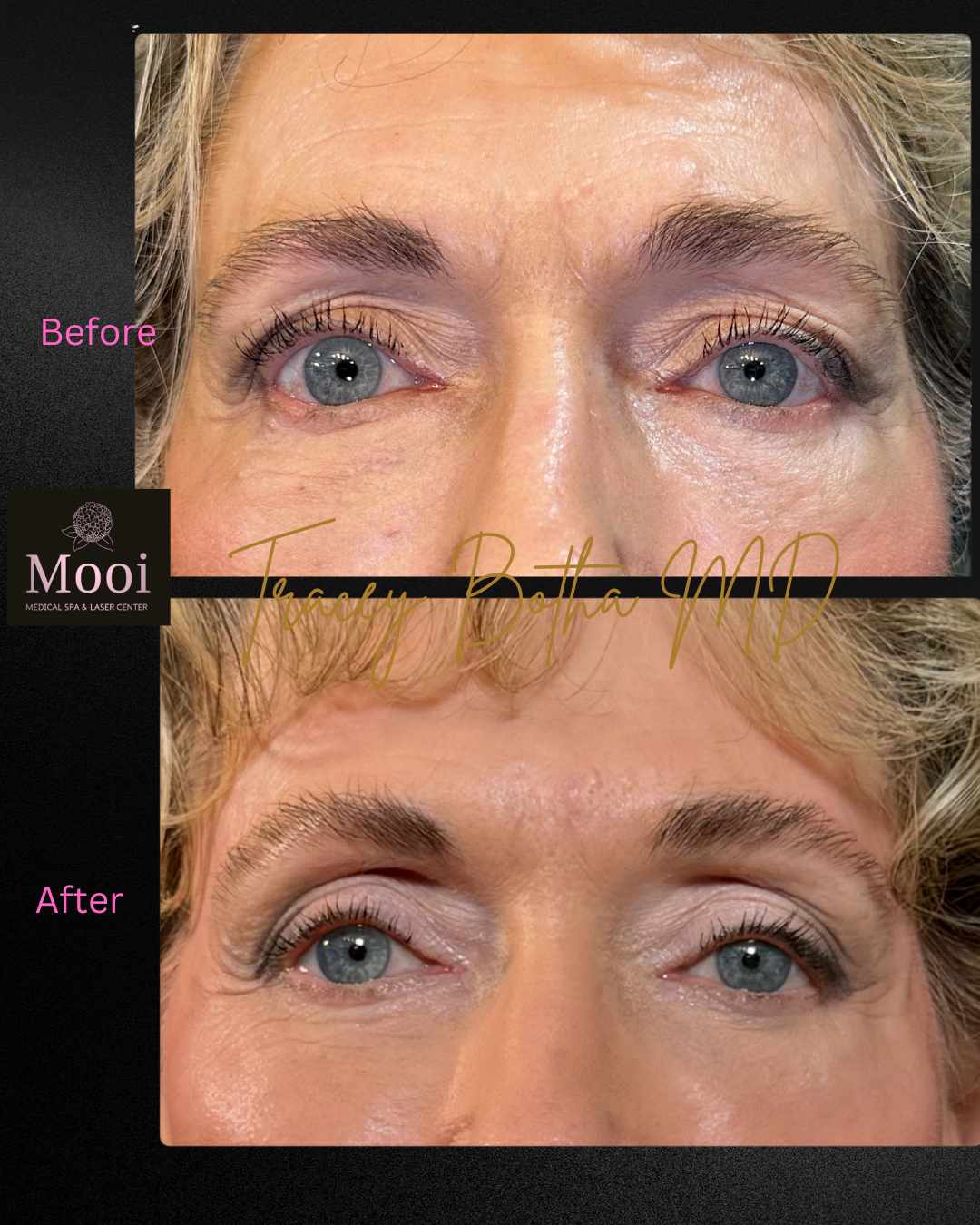 Botox