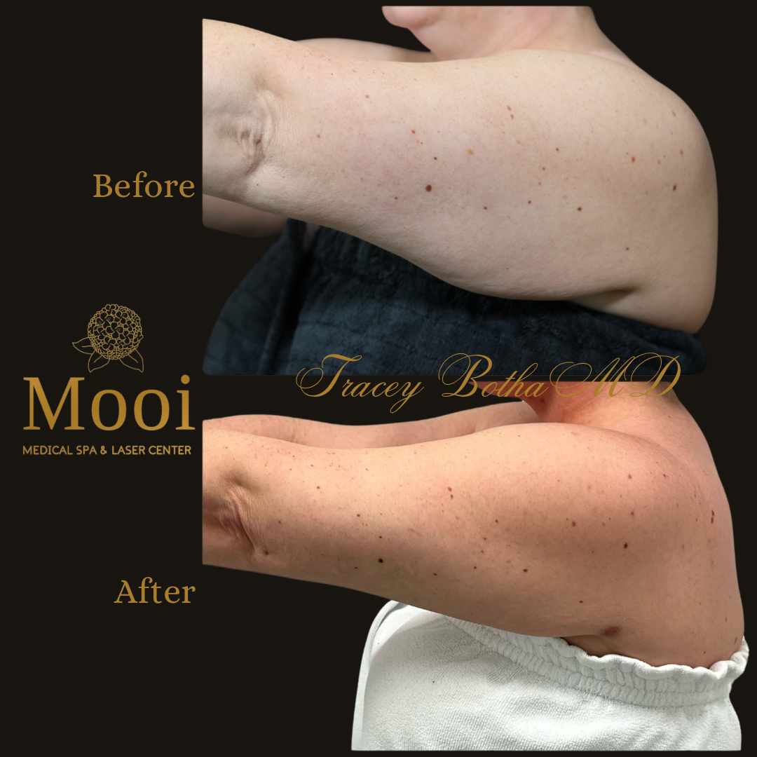 Lipo & Renuvion