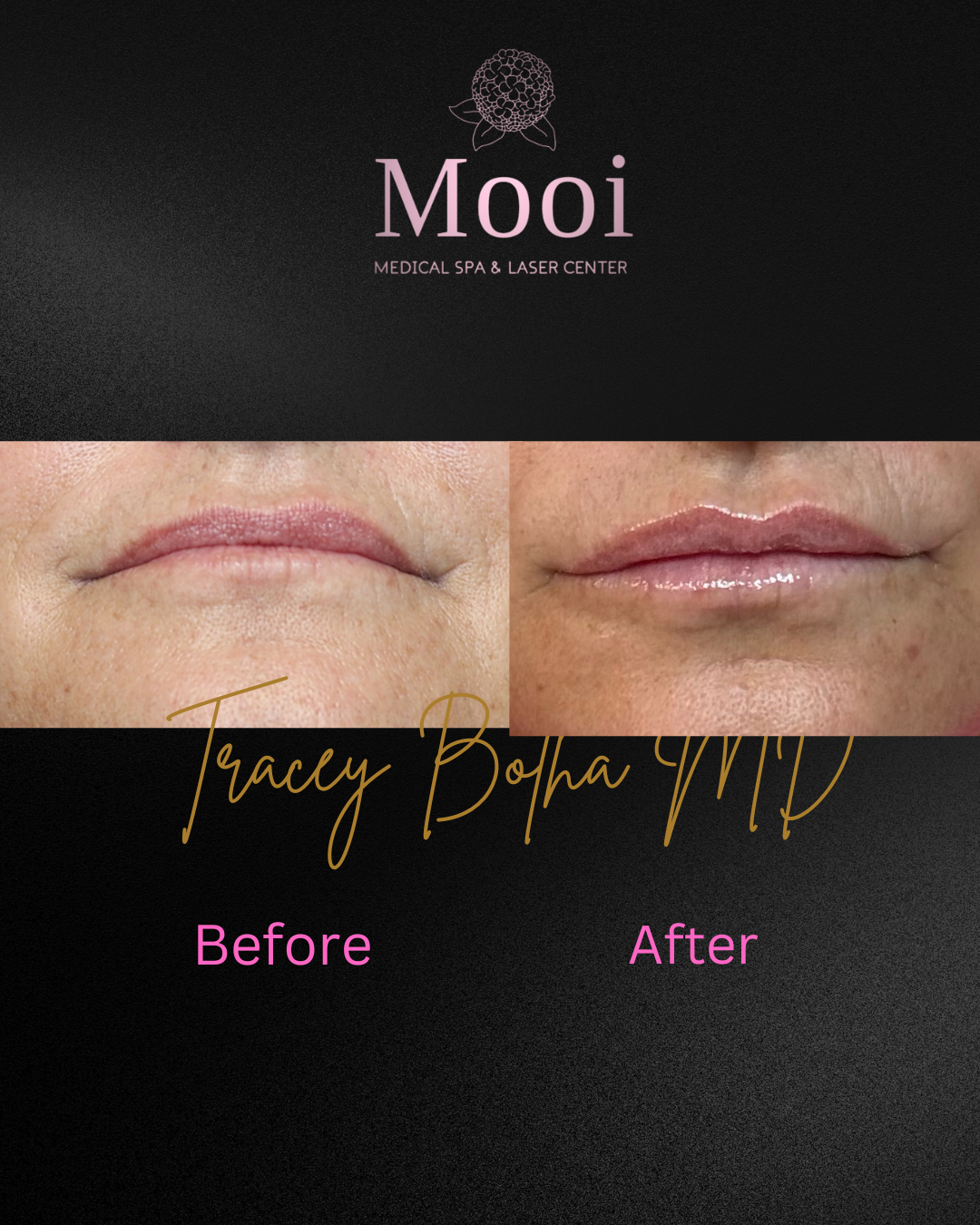 Luscious Lips-Filler