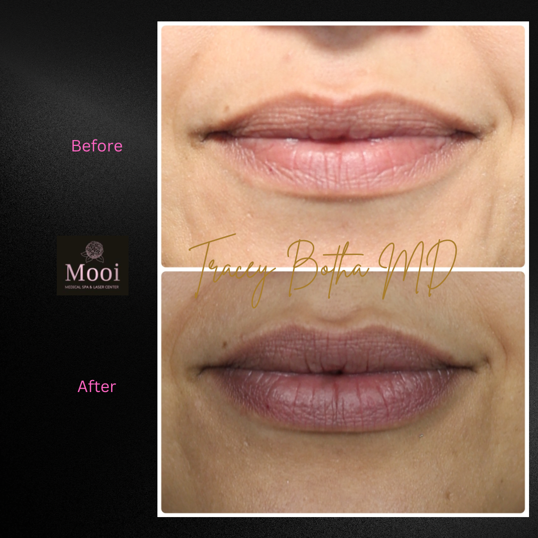 Luscious Lips-Filler