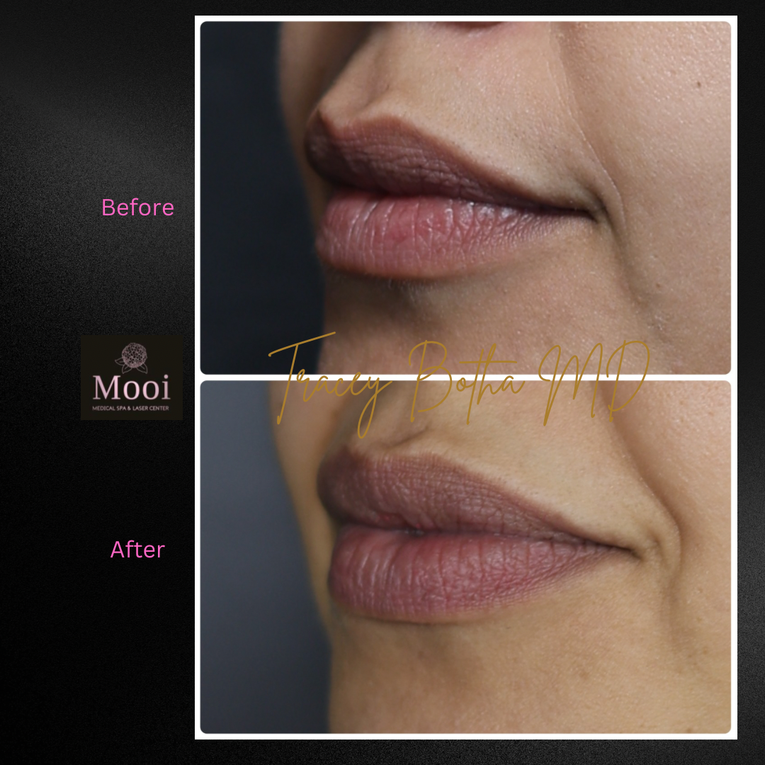 Luscious Lips-Filler