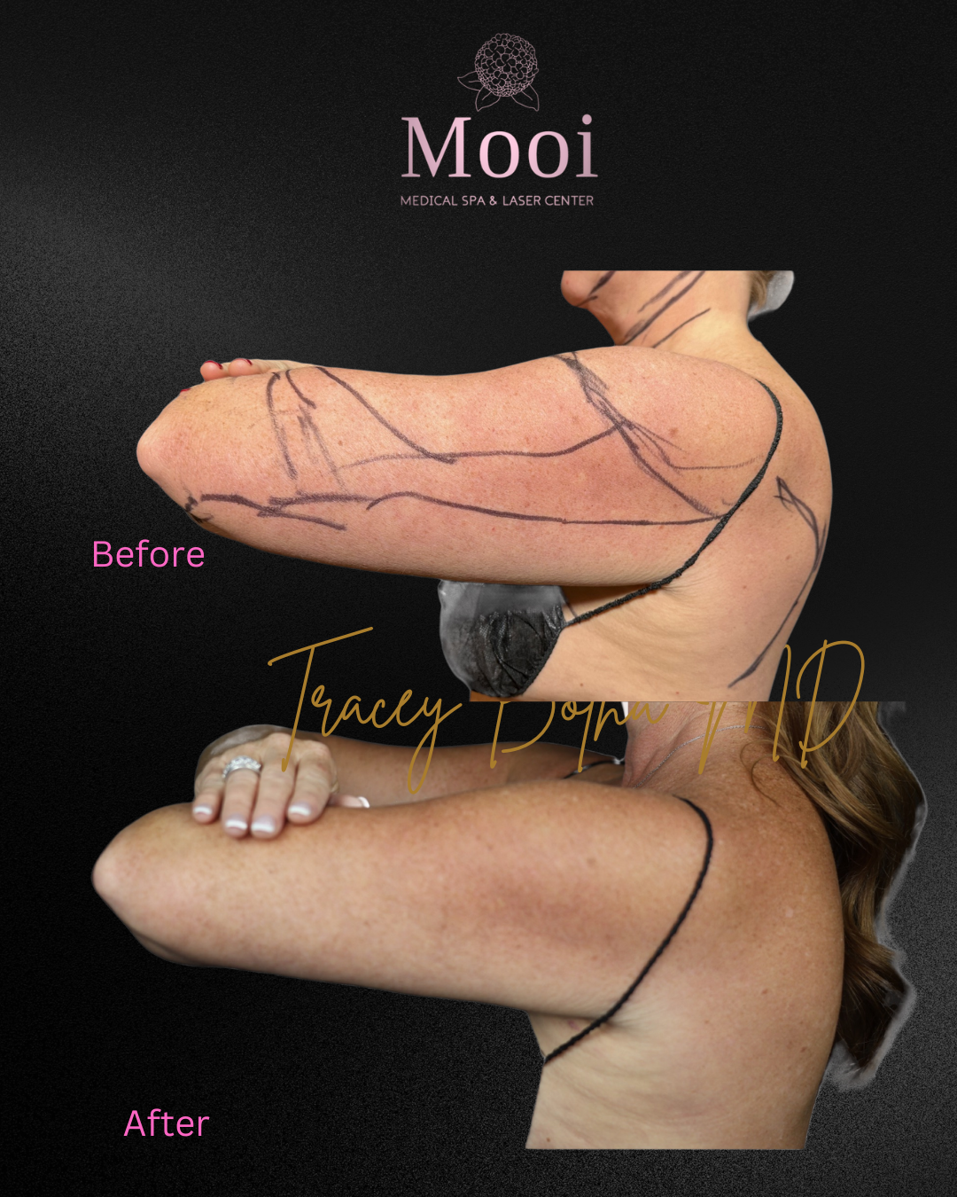 Surgical/Non-Surgical Body Sculpting
