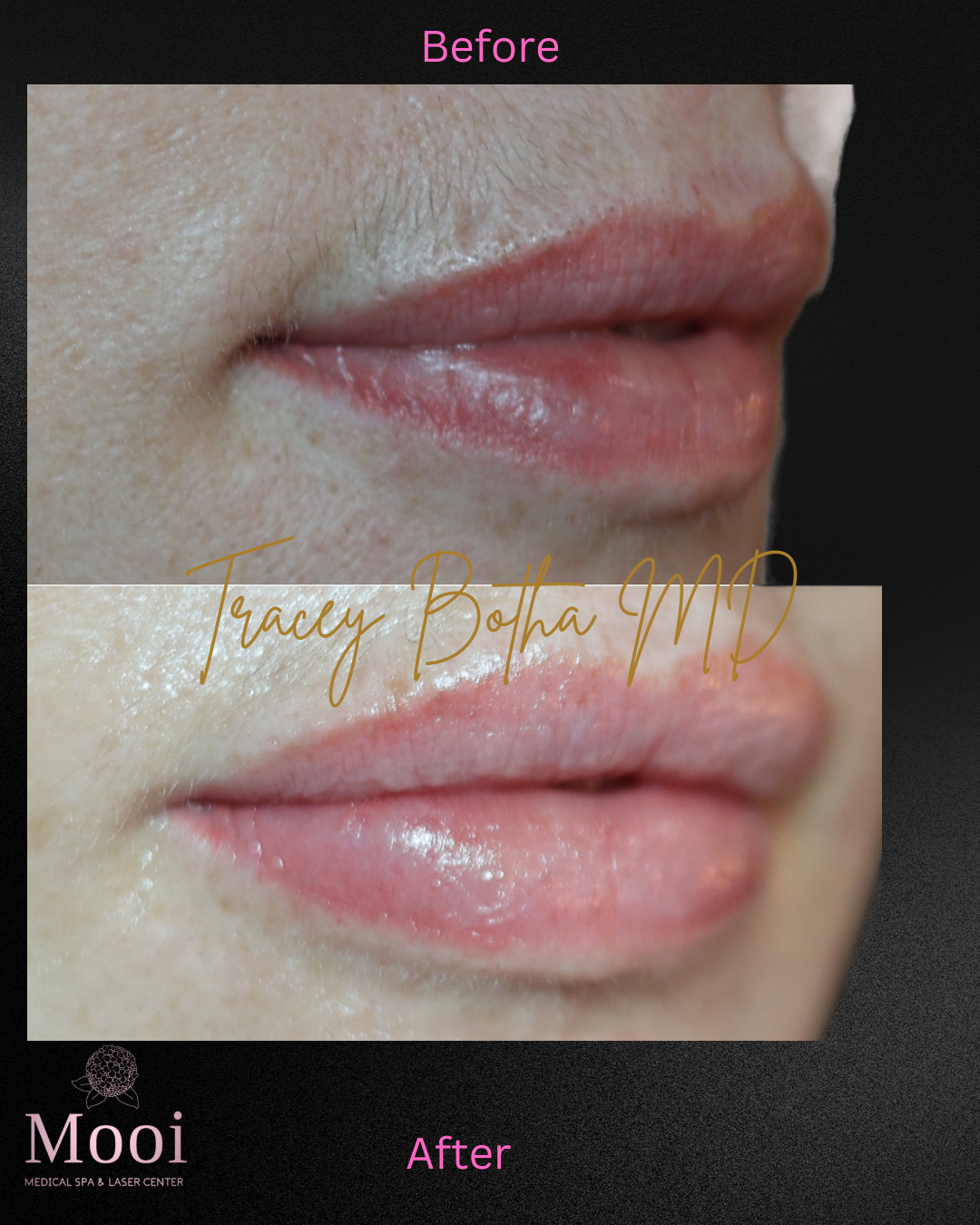 Luscious Lips-Filler
