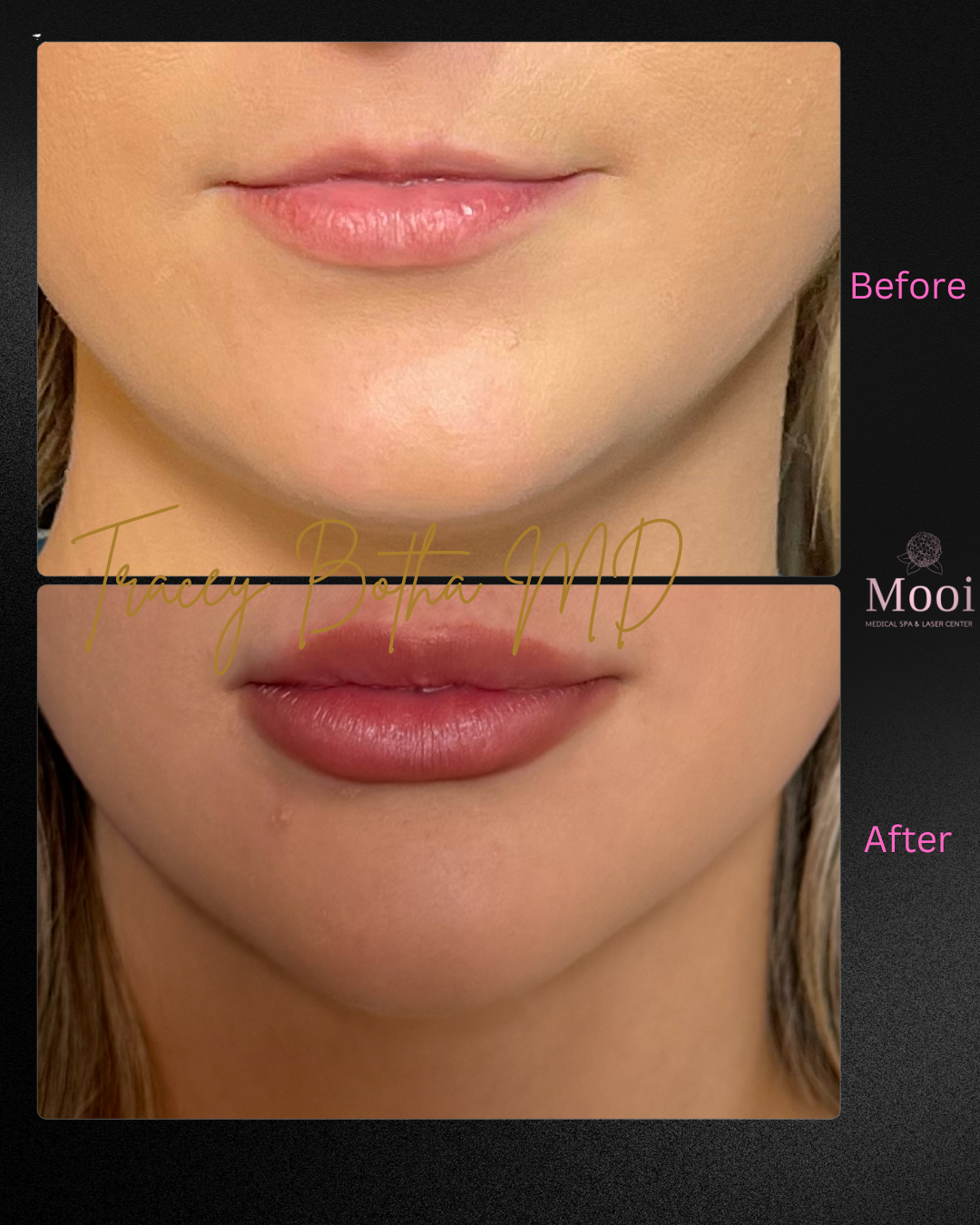 Luscious Lips-Filler