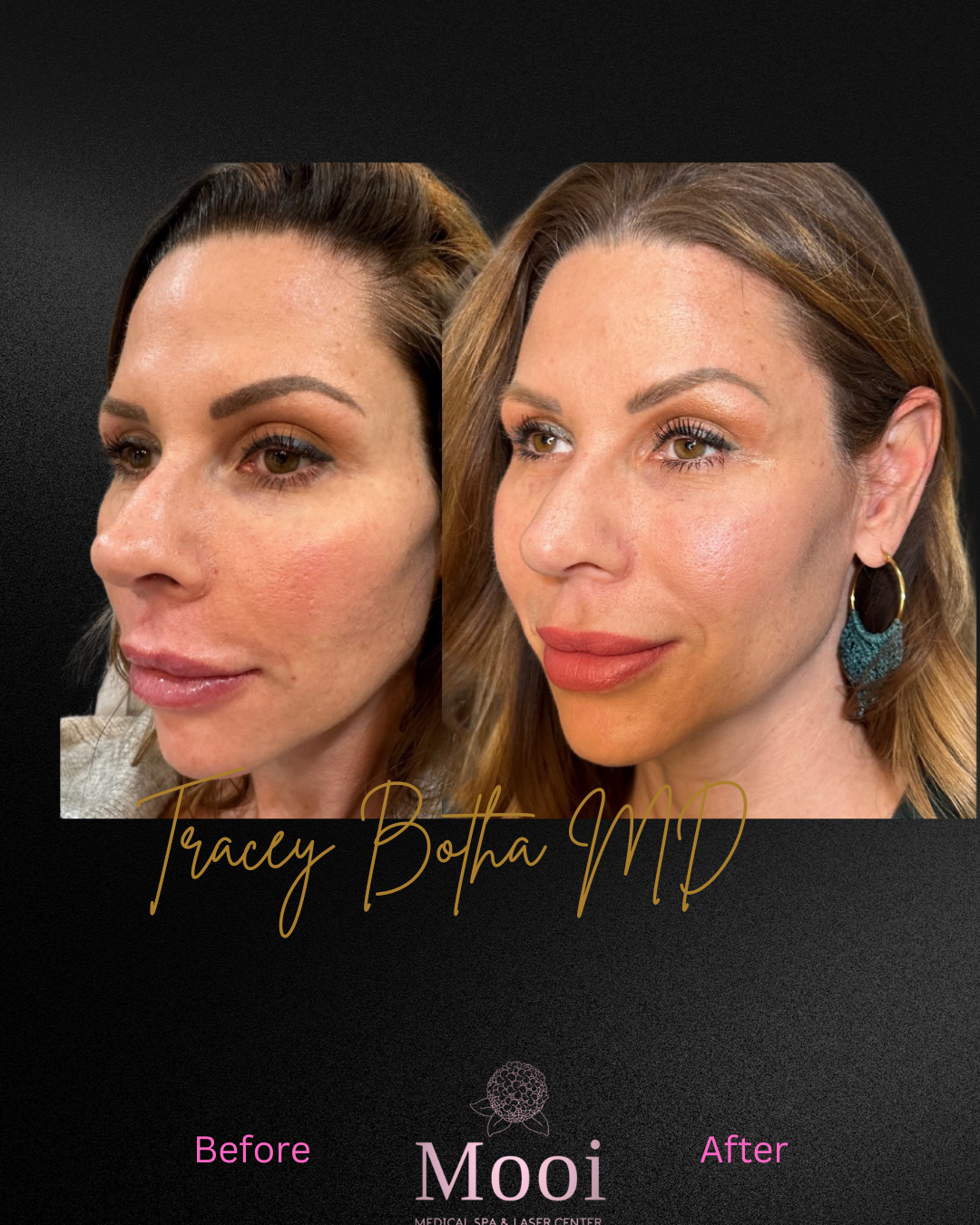 Botox
