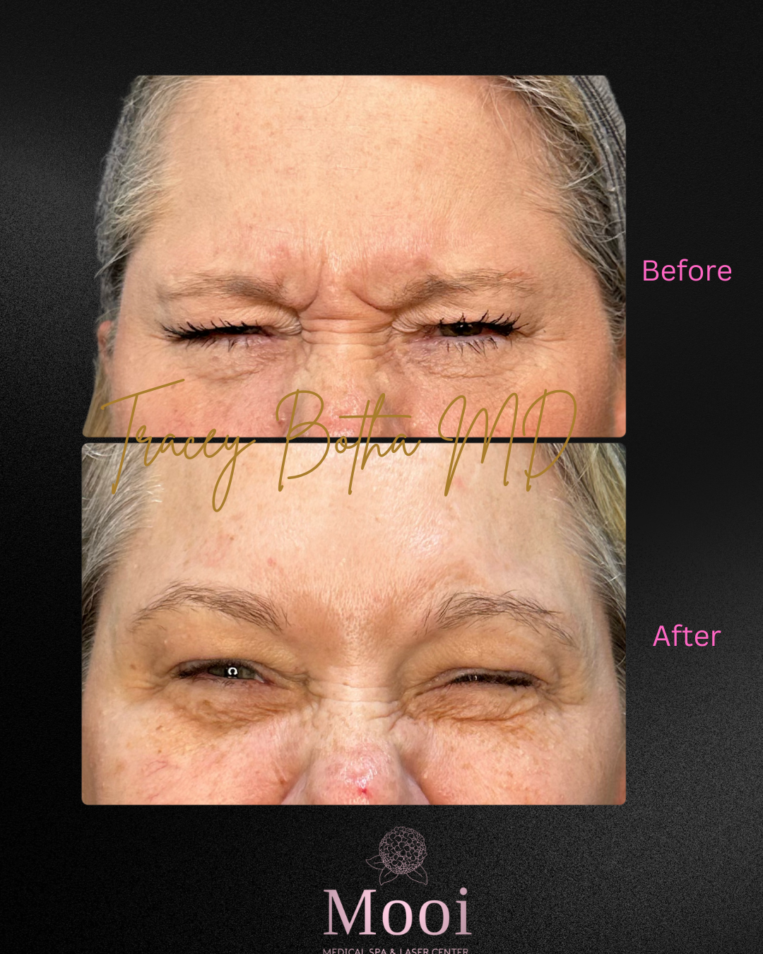 Botox