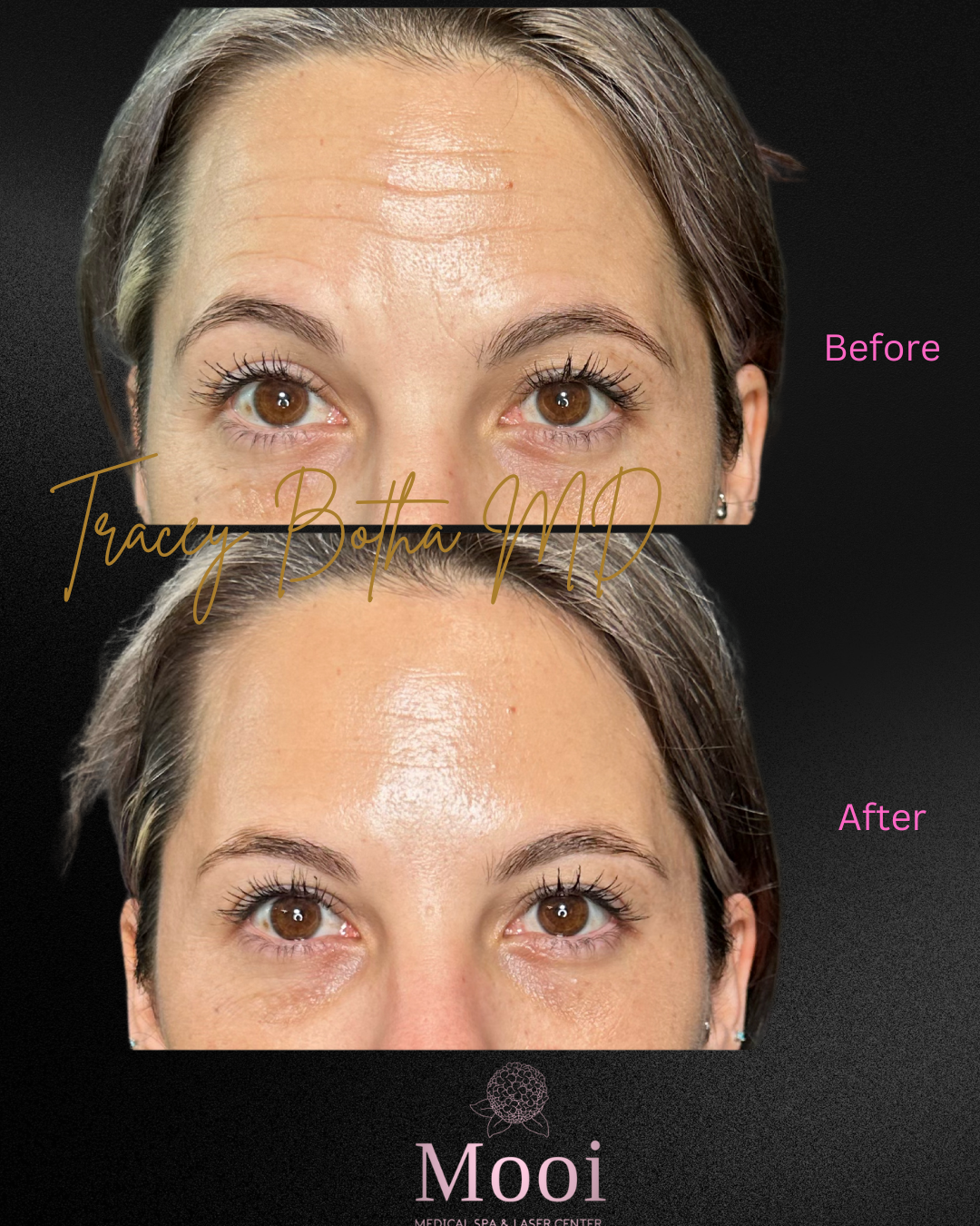 Botox