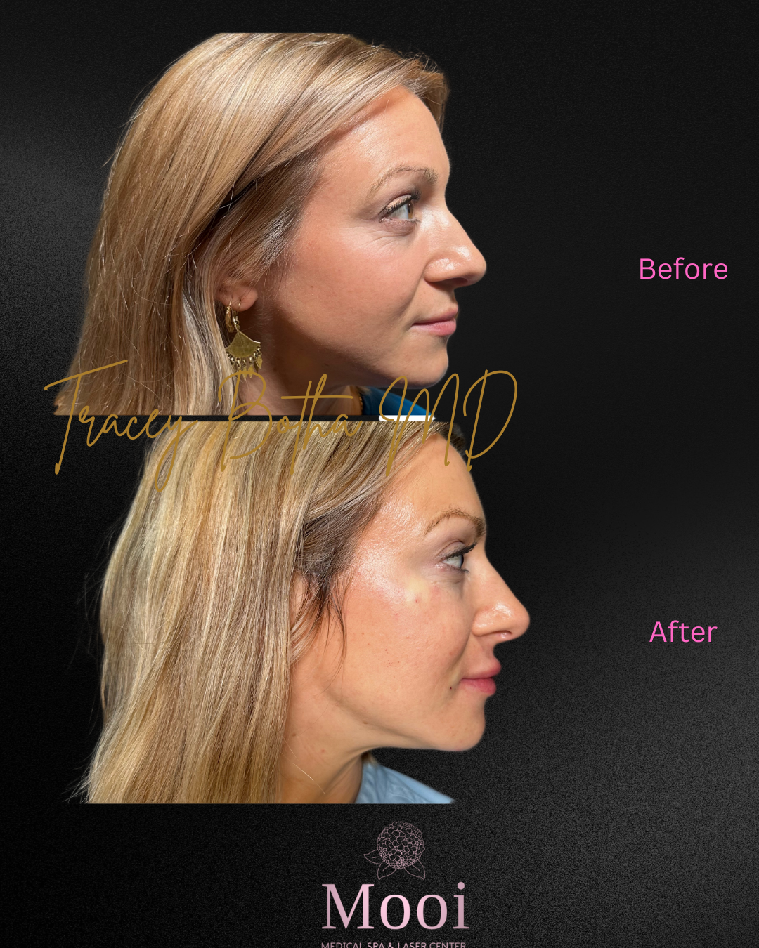 Botox