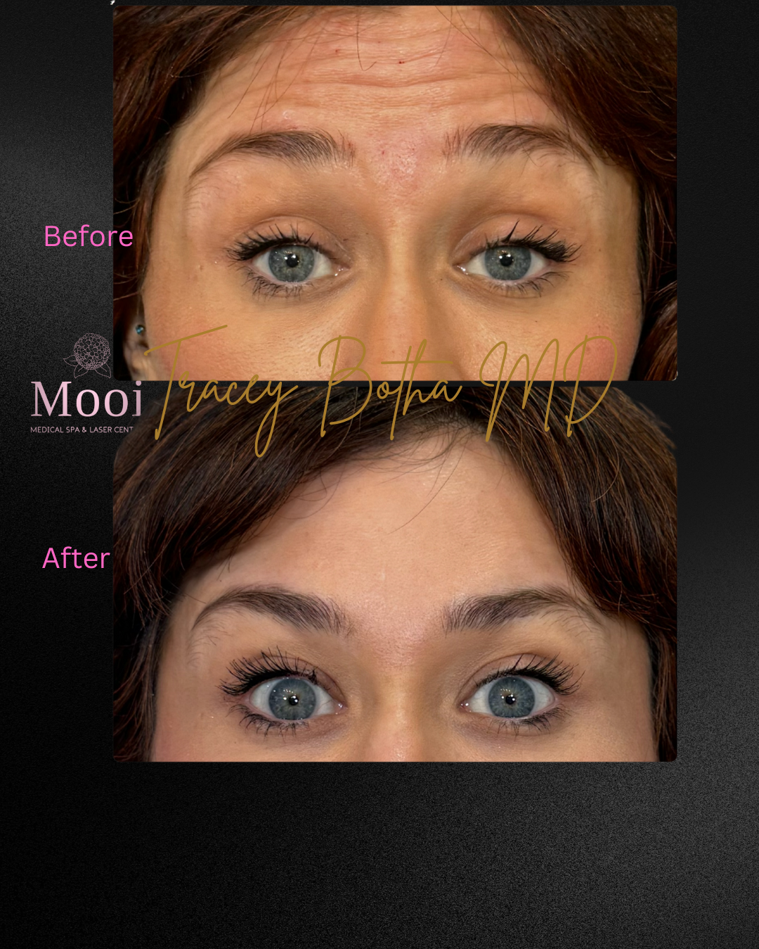 Botox