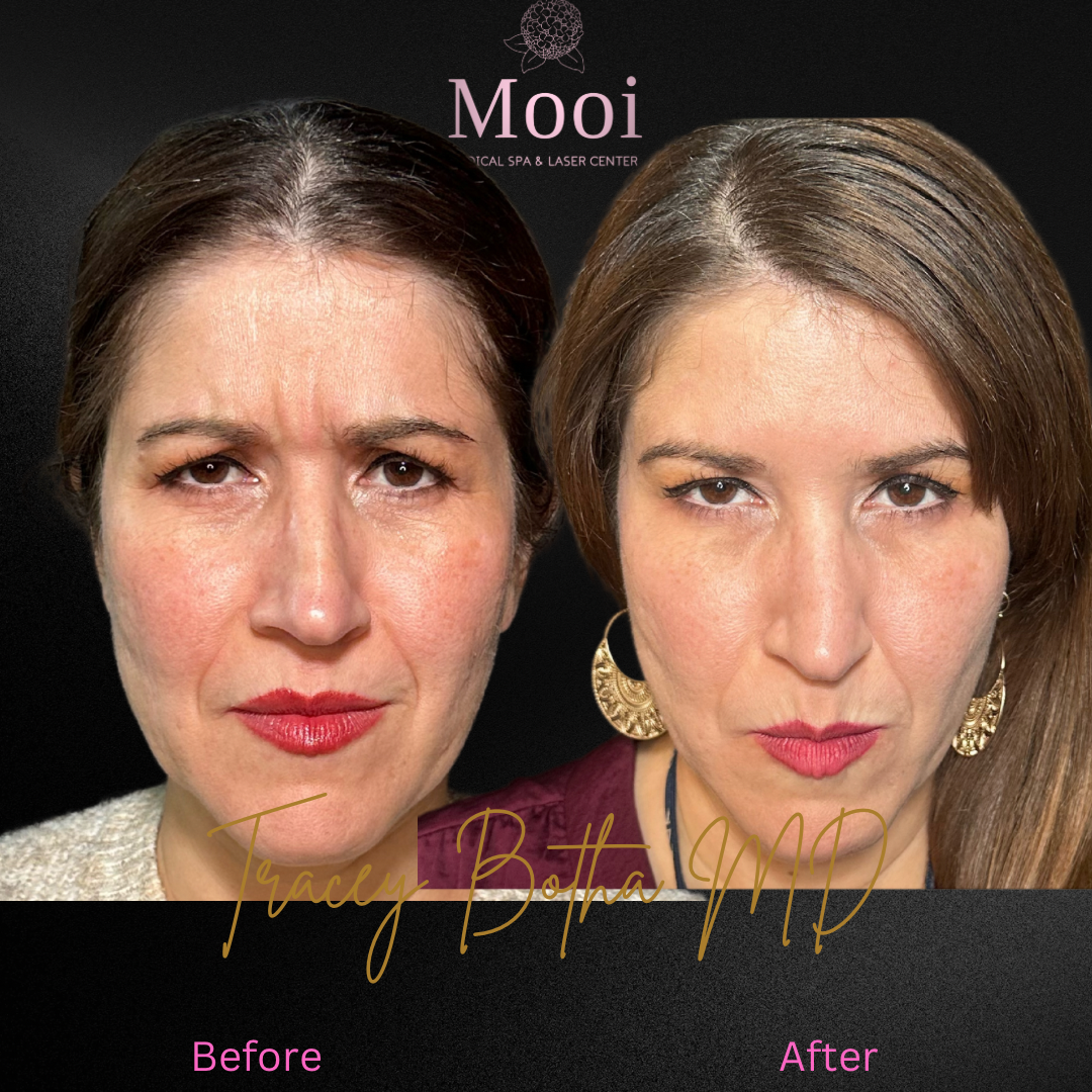 Botox
