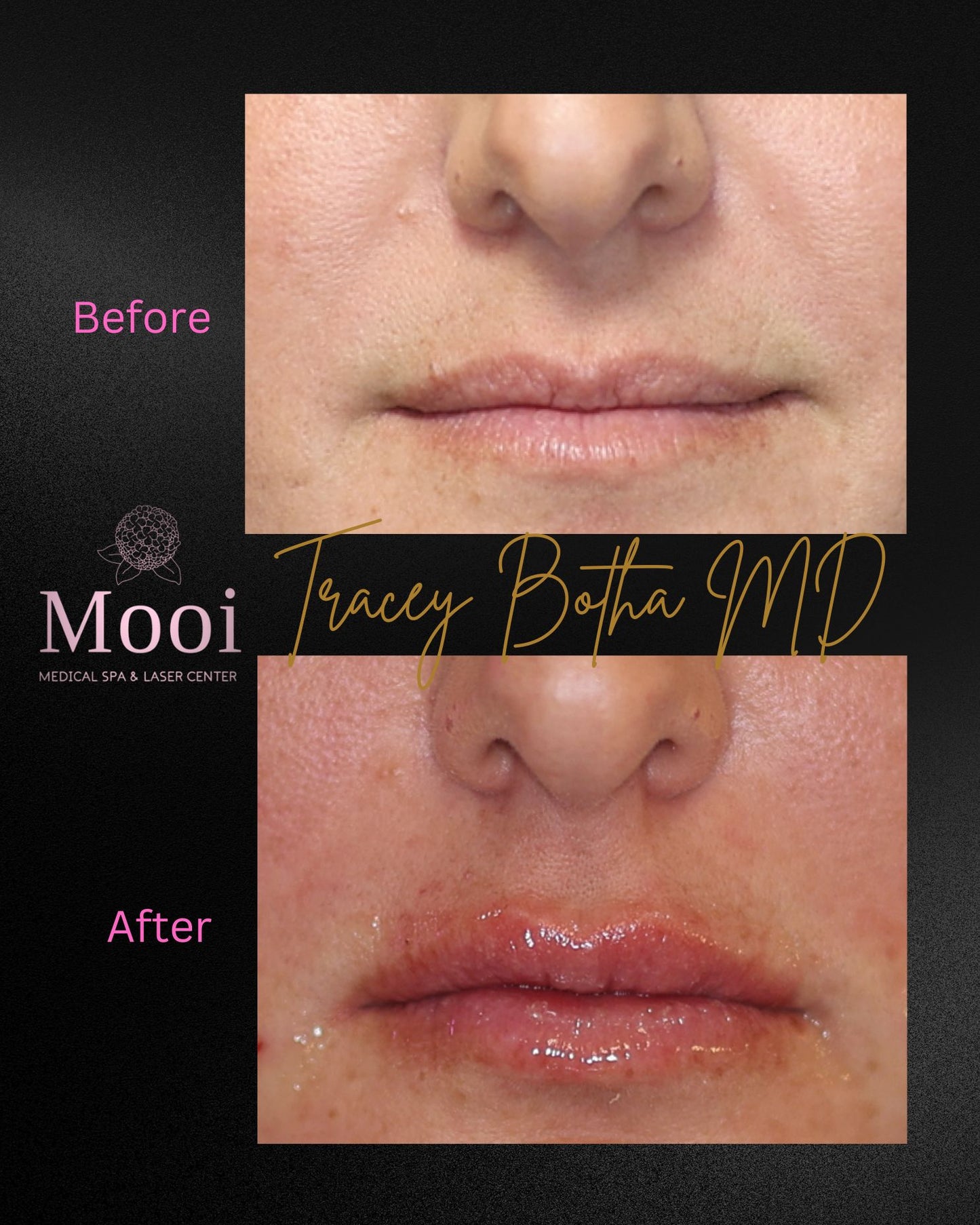 Luscious Lips-Filler