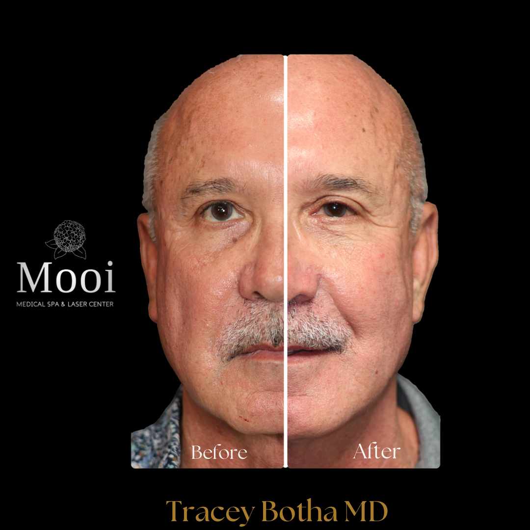 Botox