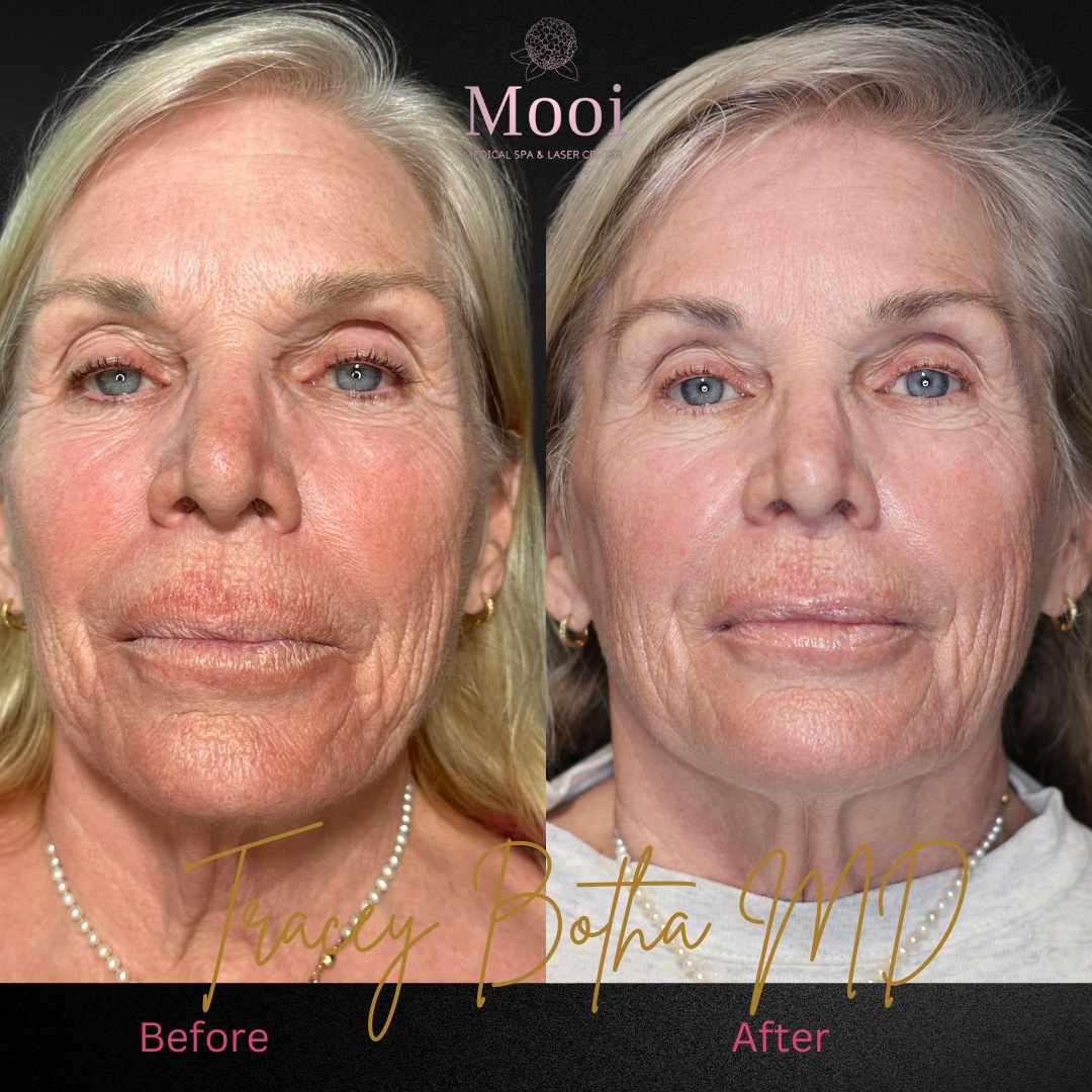 Botox