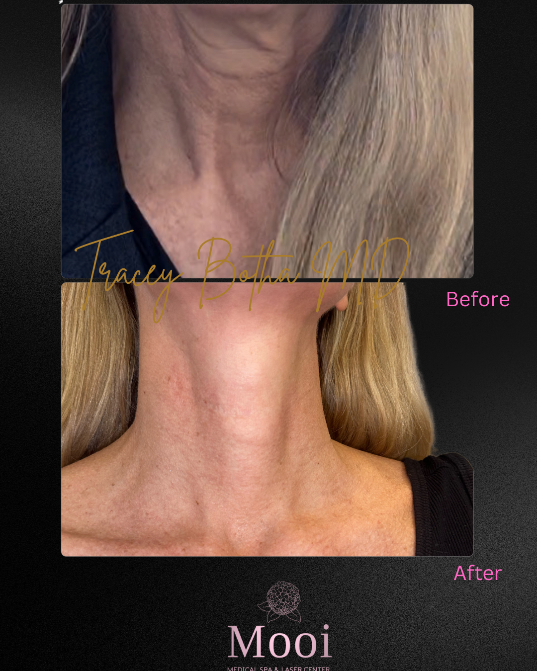 Botox