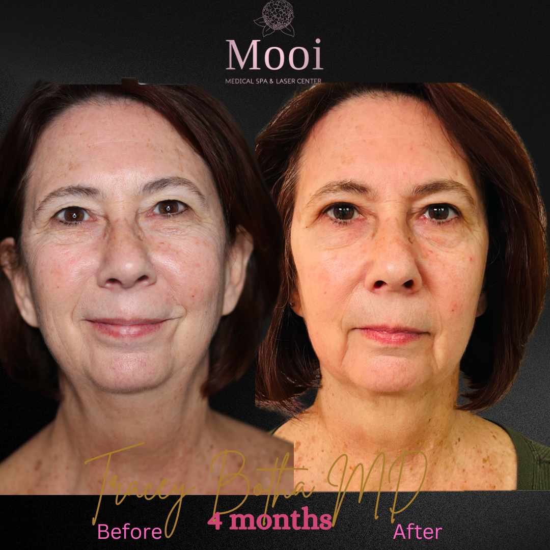 Surgical/Non-Surgical Face & Neck Tightening