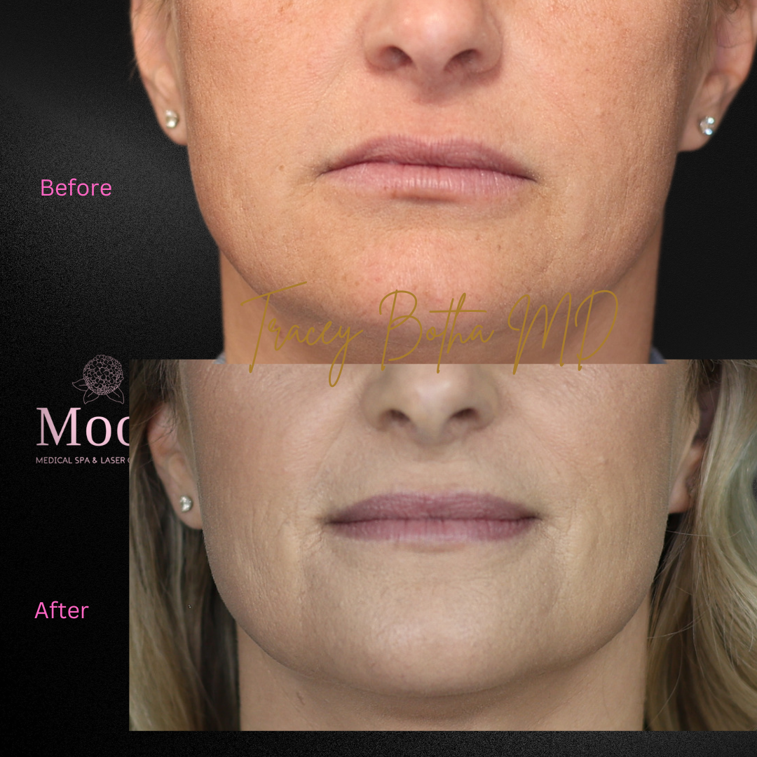 Microneedling/Radiofrequency Treatment