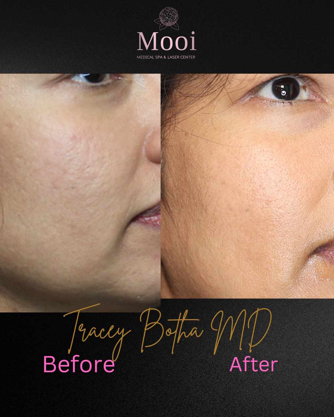 Microneedling/Radiofrequency Treatment