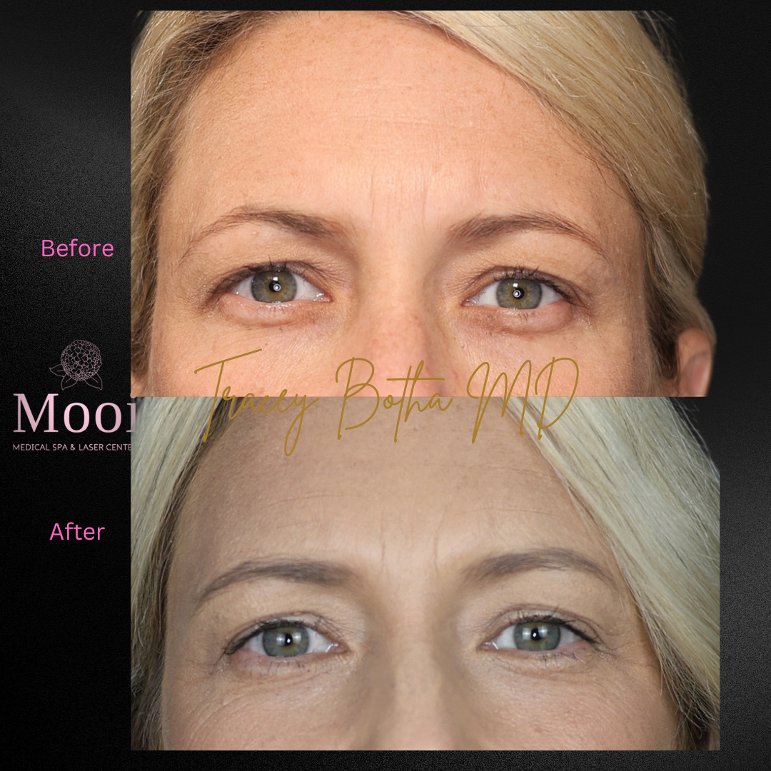 Microneedling/Radiofrequency Treatment