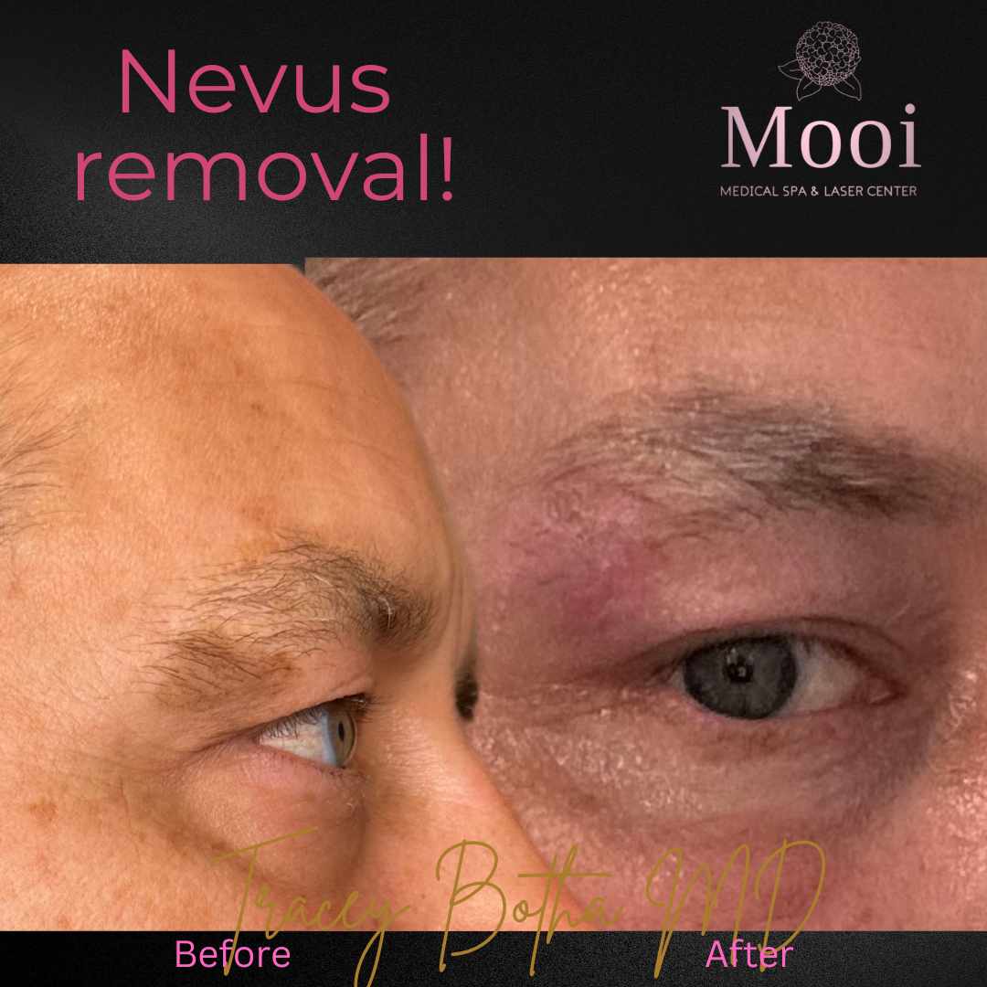 Skin Rejuvenation