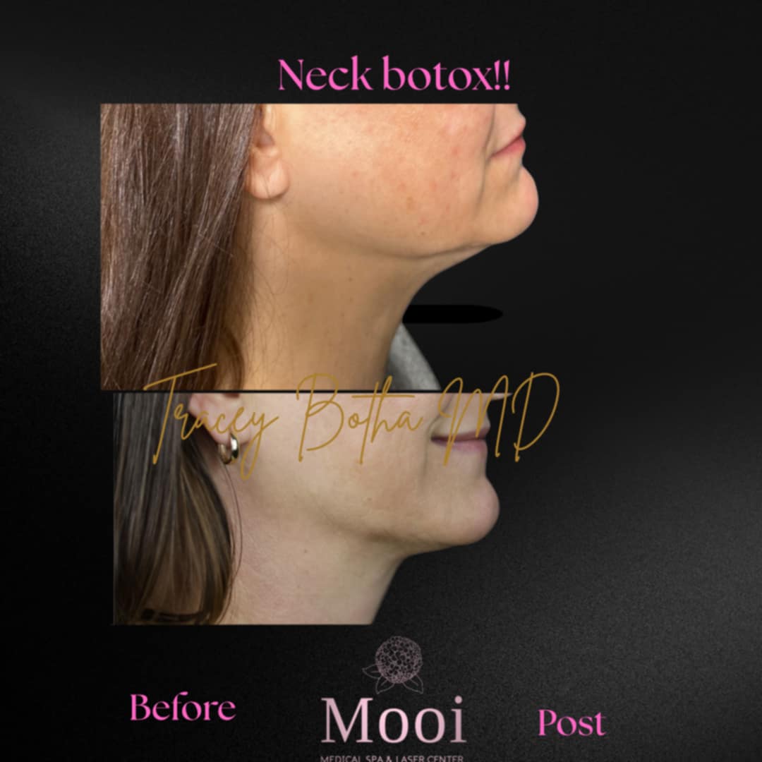 Botox