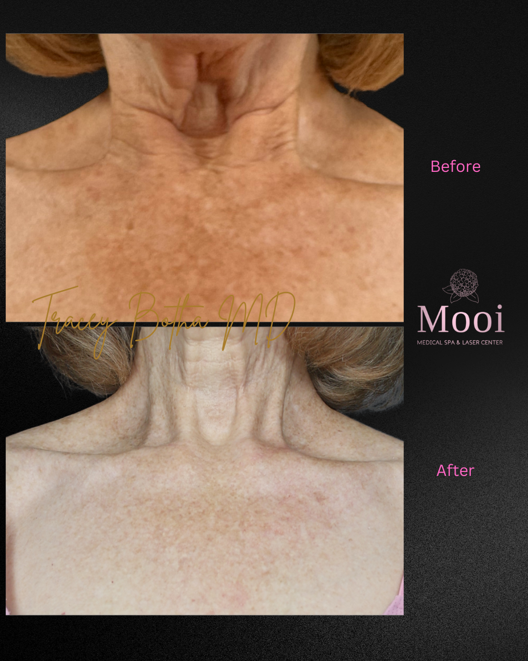 Skin Rejuvenation