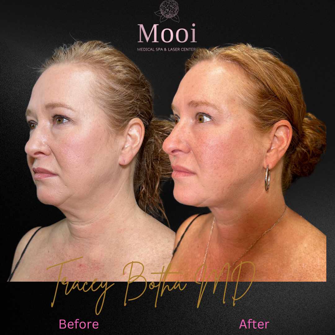 Surgical/Non-Surgical Face & Neck Tightening