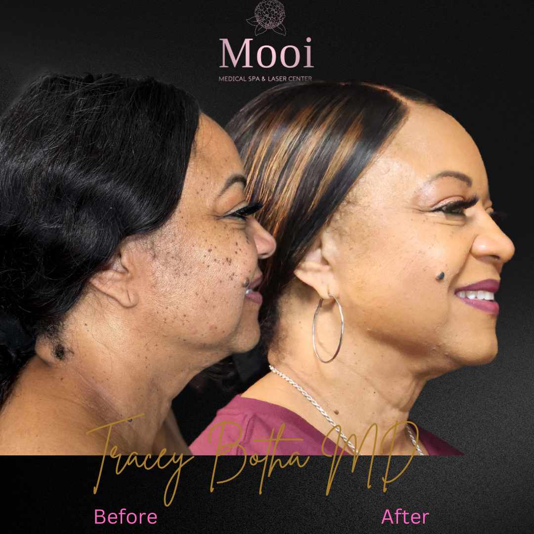 Surgical/Non-Surgical Face & Neck Tightening
