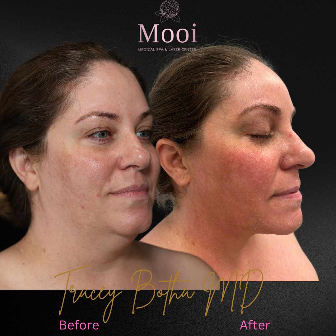Lipo & Renuvion