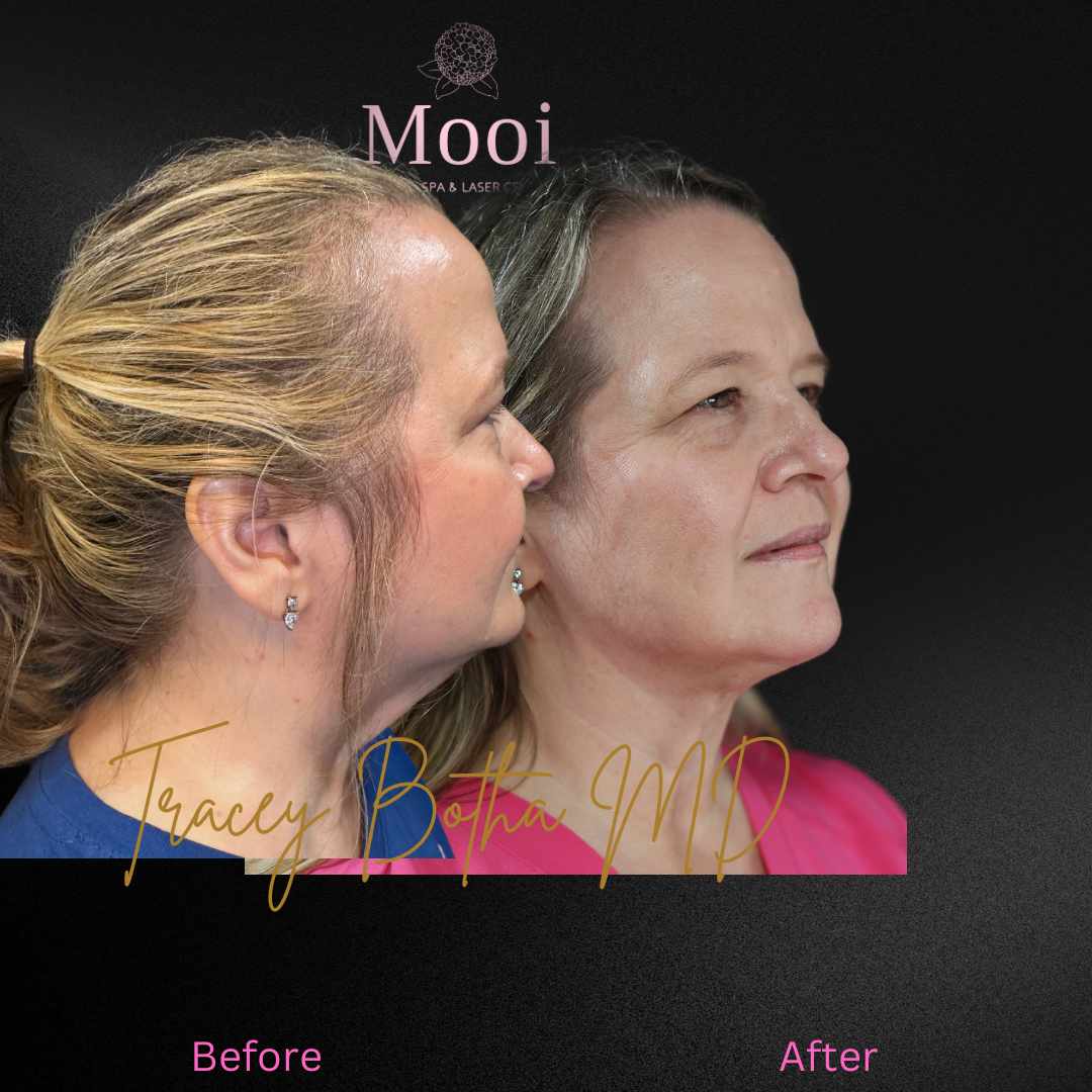 Surgical/Non-Surgical Face & Neck Tightening