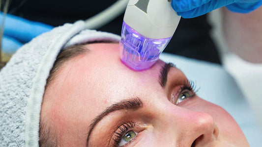 Microneedling/Radiofrequency Treatment
