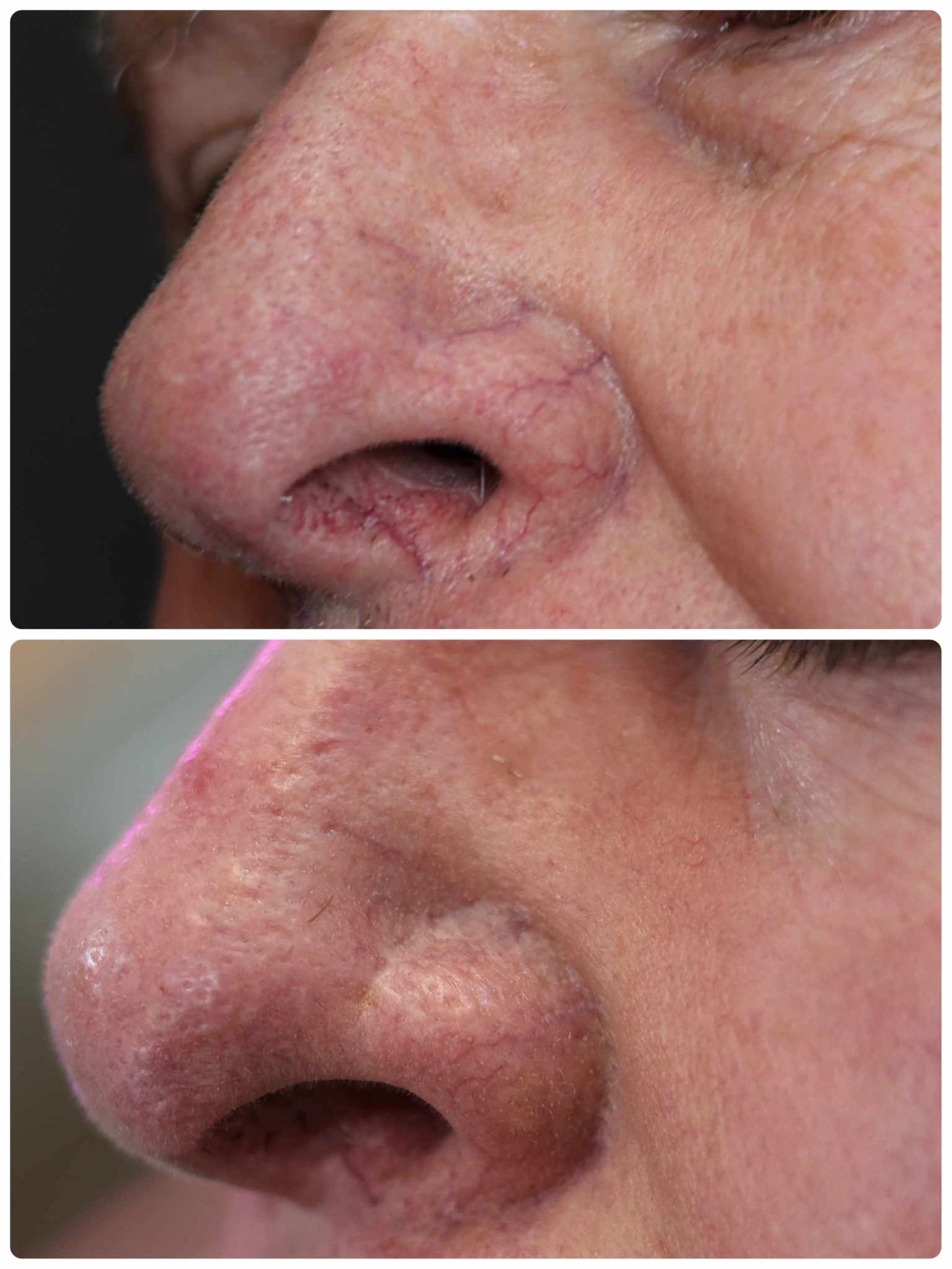before and after of mans nose for scar treatment at an angle