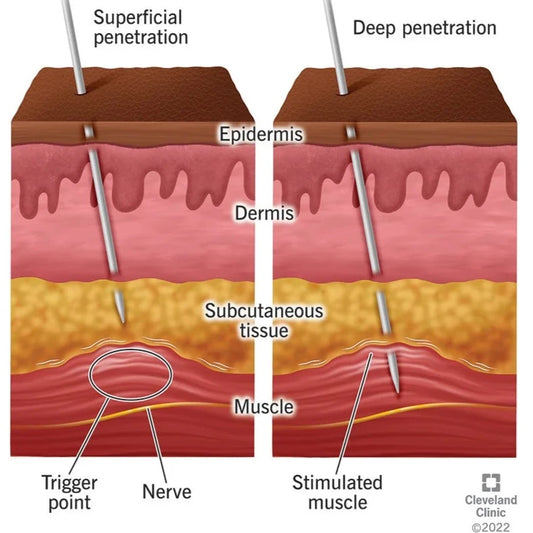 Back, Hip, and Pelvic Dry Needling