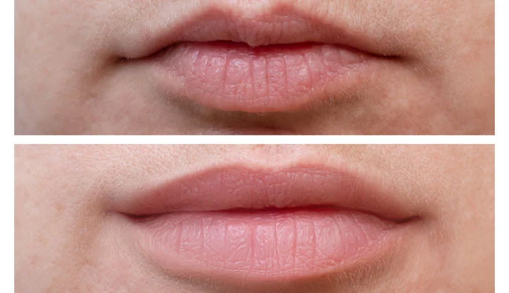 Before and after images of lip flip procedure results, showing increased lip volume.