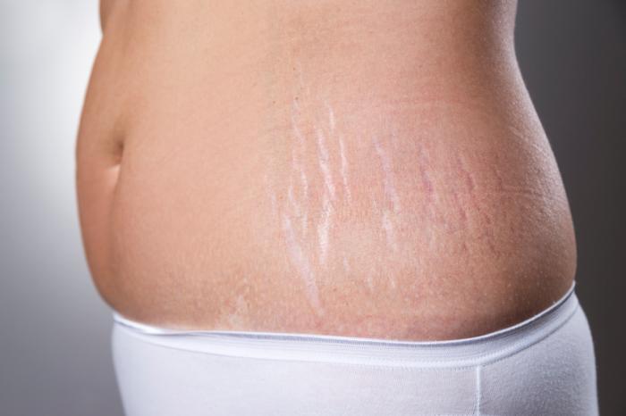 Stretch Mark Treatment Consult