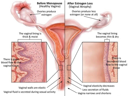 Vaginal Rejuvination