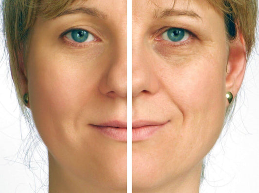 Non-Surgical Blepharoplasty