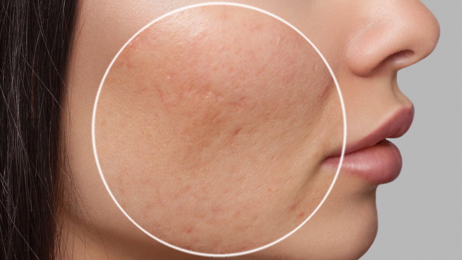 Scar Treatments – Mooi Medical Spa & Laser Center