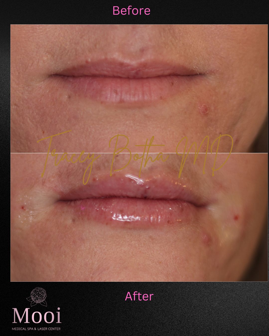 Luscious Lips-Filler
