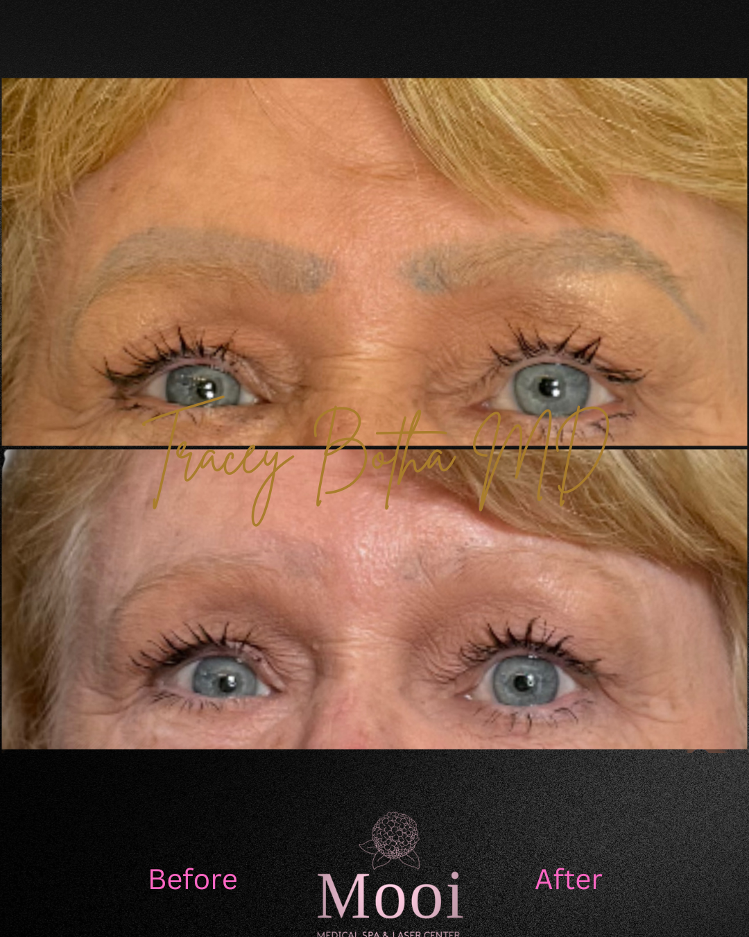 Tattoo Removal