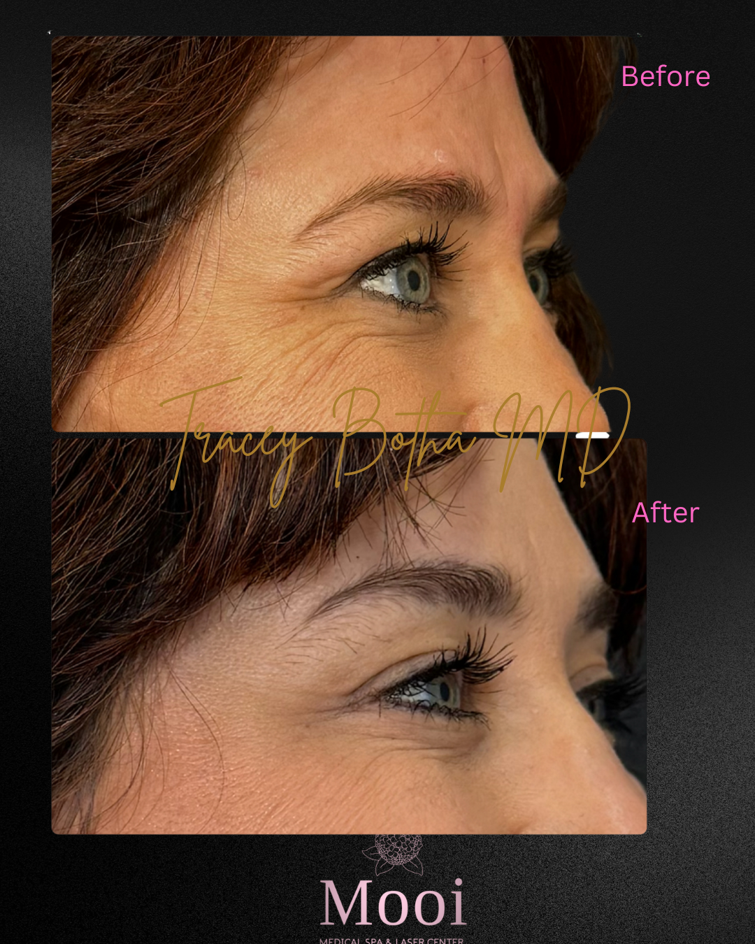 Botox