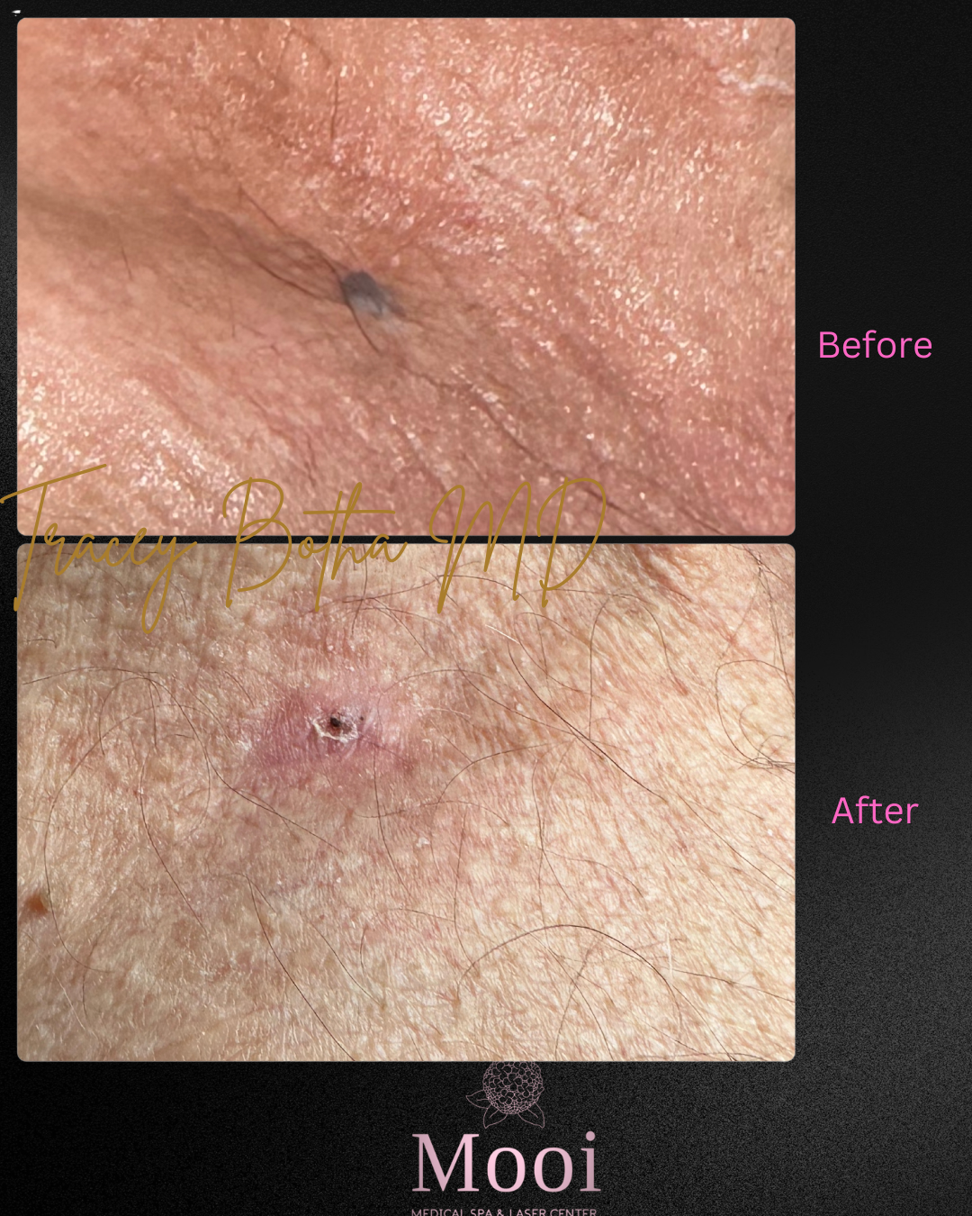 Skin Rejuvenation
