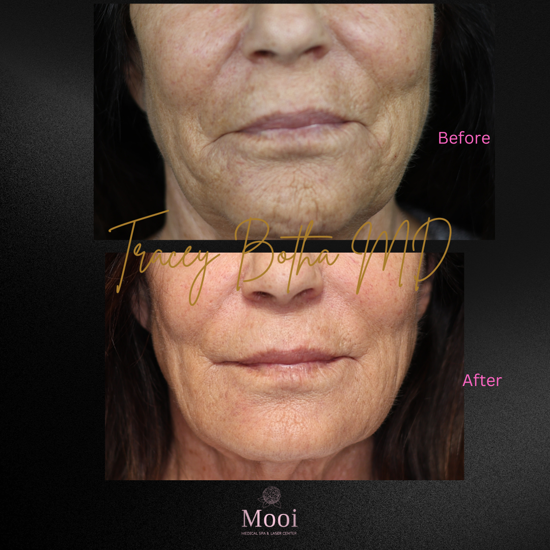 Biostimulators