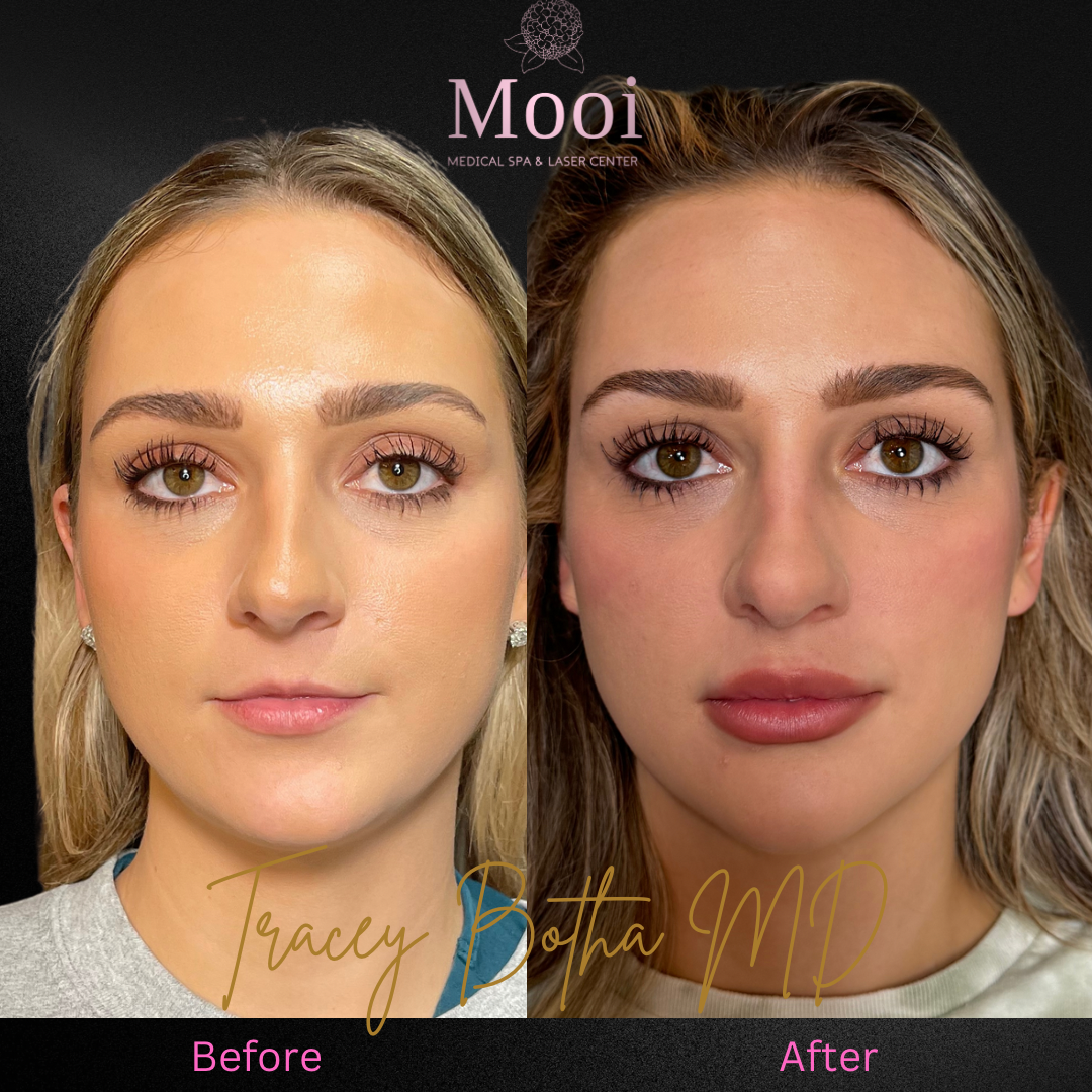 before and after of young woman with filler